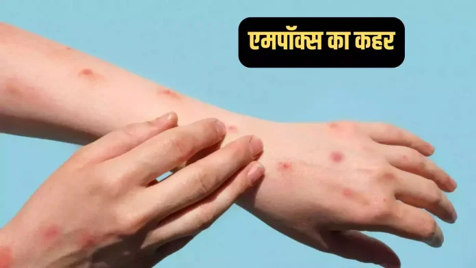 एमपॉक्स का डर