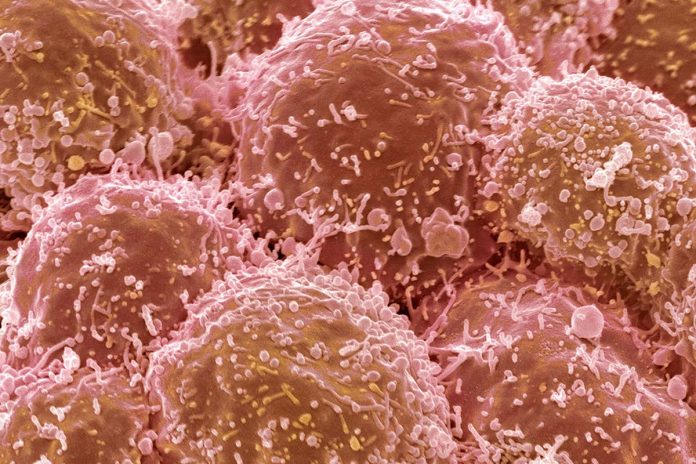 HamaraTimes.com | Two children with cancer may have acquired tumour cells before birth